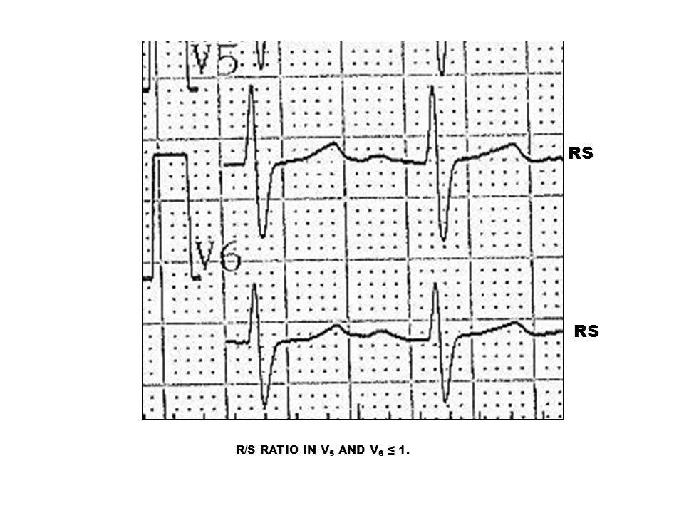 RS RS R/S RATIO IN V5 AND V6 ≤ 1.