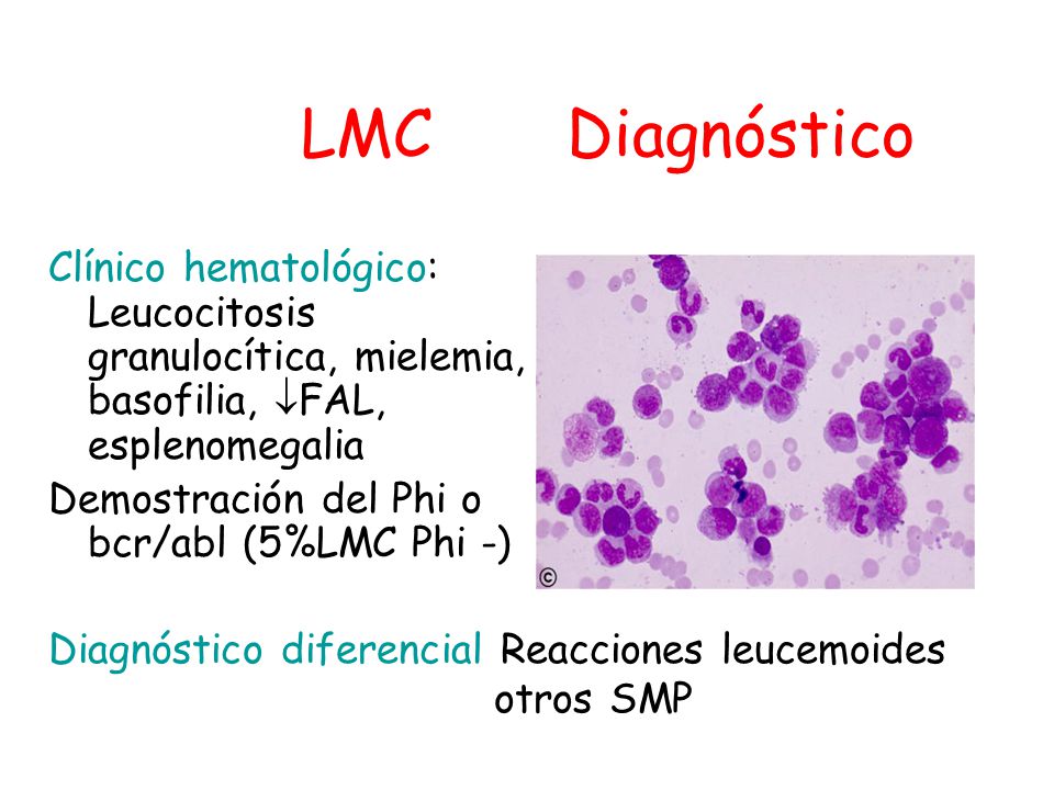 LMC Diagnóstico Clínico hematológico: Leucocitosis granulocítica, mielemia, basofilia, FAL, esplenomegalia.