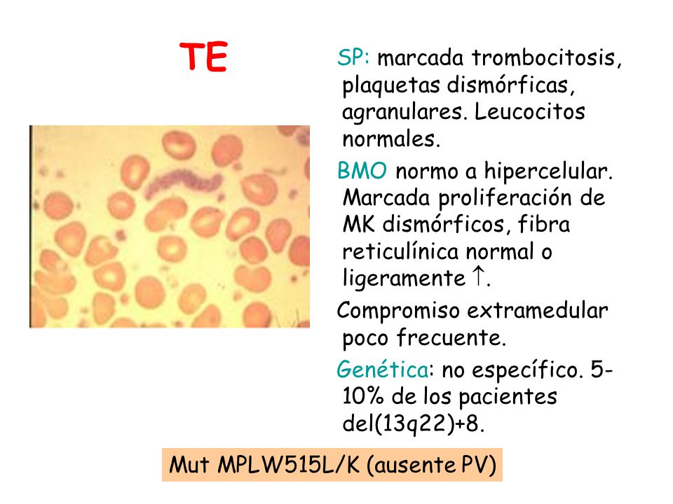 TE SP: marcada trombocitosis, plaquetas dismórficas, agranulares. Leucocitos normales.