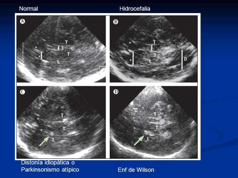 Normal Hidrocefalia Distonía idiopática o Parkinsonismo atípico Enf de Wilson