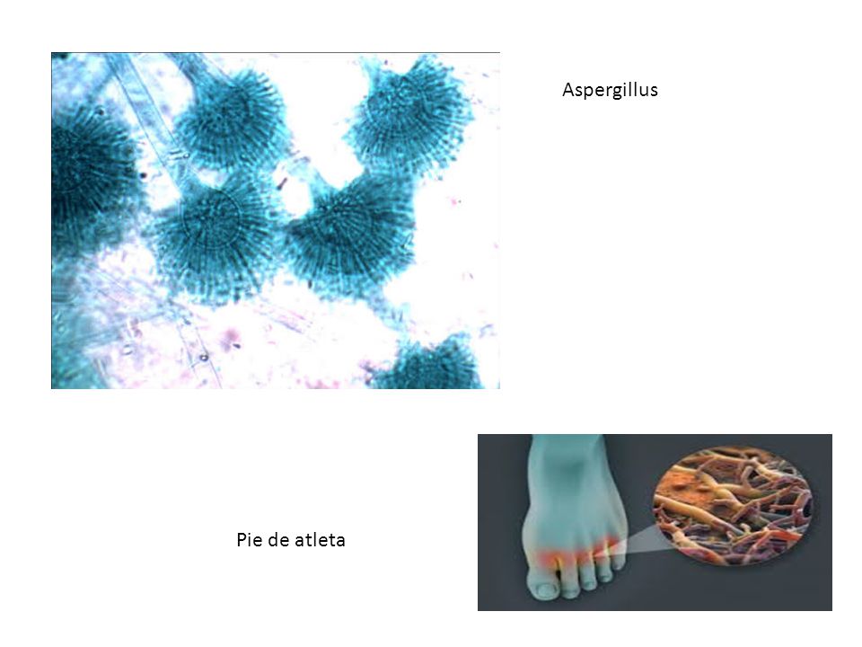 Aspergillus Pie de atleta