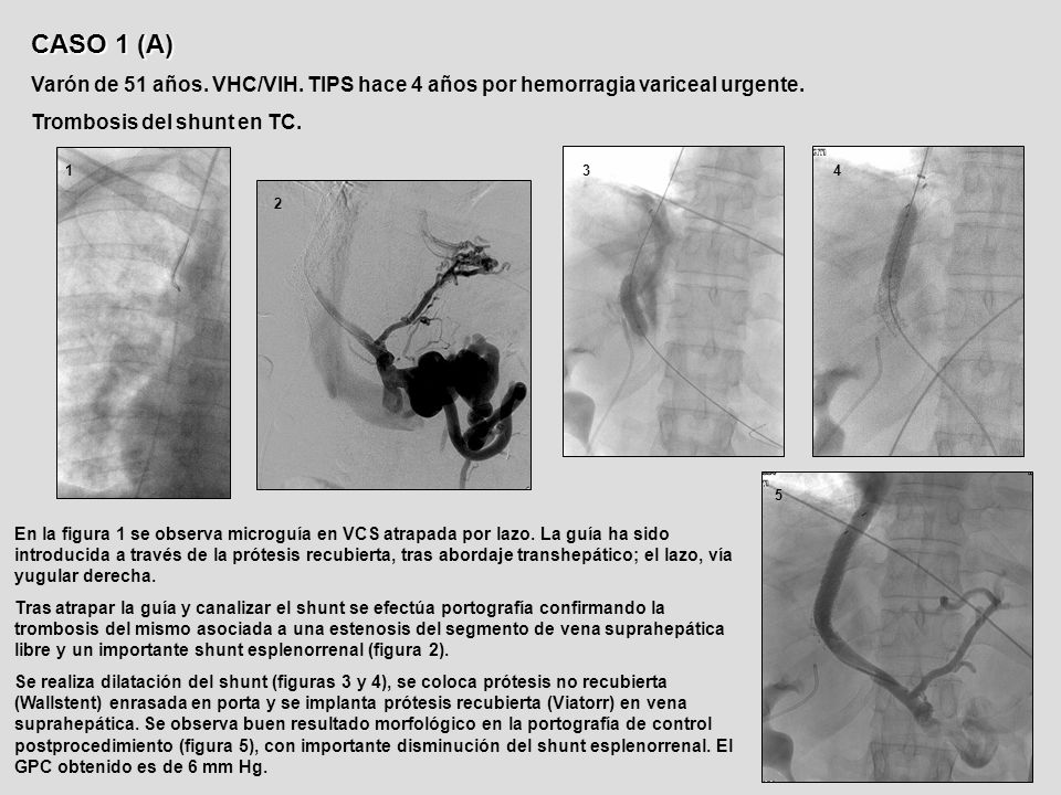 CASO 1 (A) Varón de 51 años. VHC/VIH. TIPS hace 4 años por hemorragia variceal urgente. Trombosis del shunt en TC.