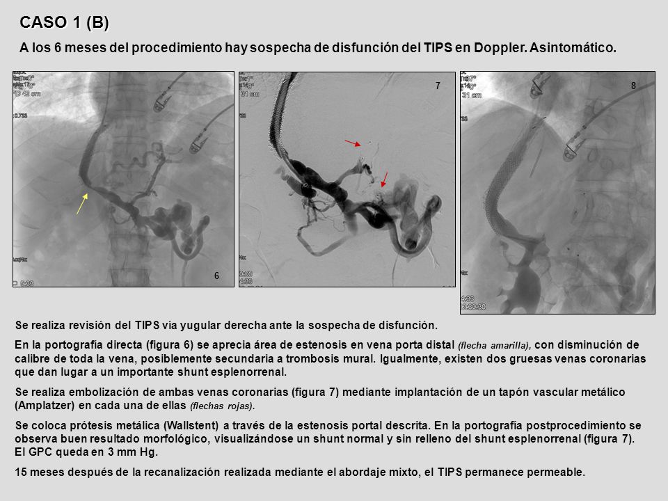 CASO 1 (B) A los 6 meses del procedimiento hay sospecha de disfunción del TIPS en Doppler. Asintomático.