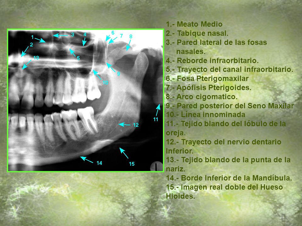 1.- Meato Medio 2.- Tabique nasal. 3.- Pared lateral de las fosas. nasales. 4.- Reborde infraorbitario.