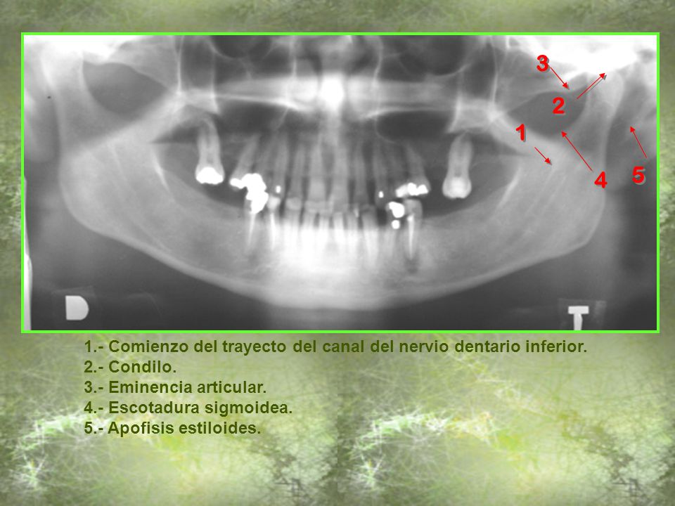 Comienzo del trayecto del canal del nervio dentario inferior. 2.- Condilo. 3.- Eminencia articular.