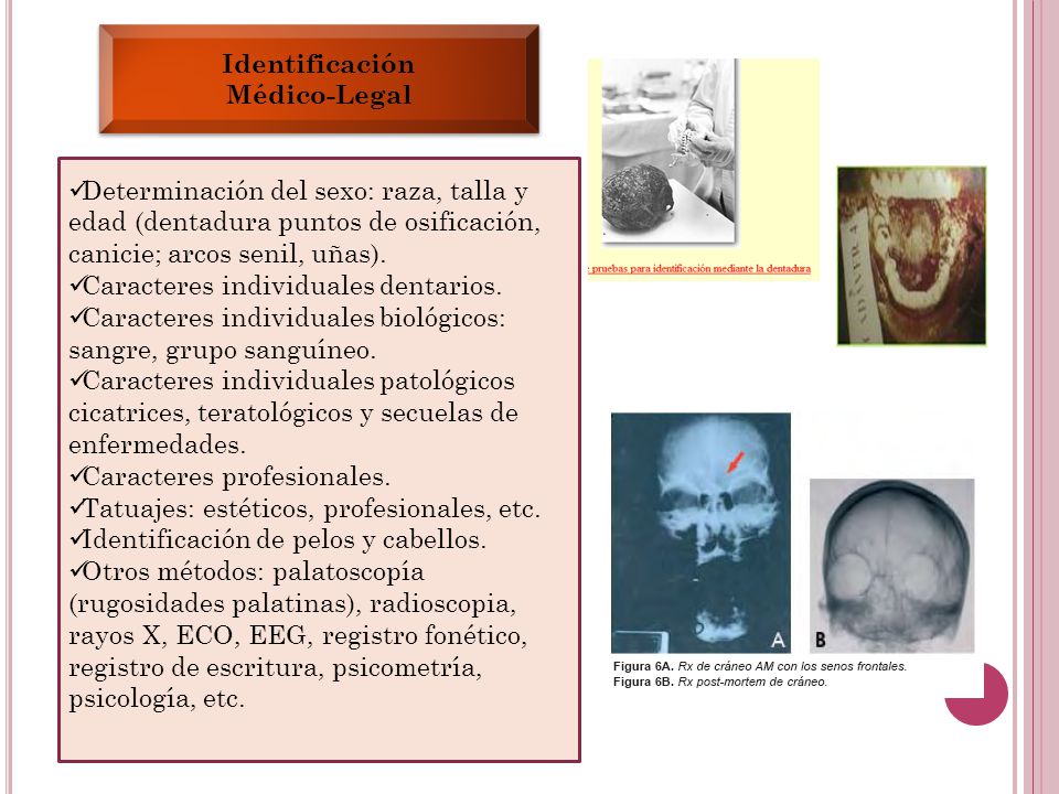 Identificación Médico-Legal. Determinación del sexo: raza, talla y edad (dentadura puntos de osificación, canicie; arcos senil, uñas).