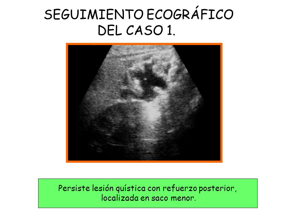 SEGUIMIENTO ECOGRÁFICO DEL CASO 1.
