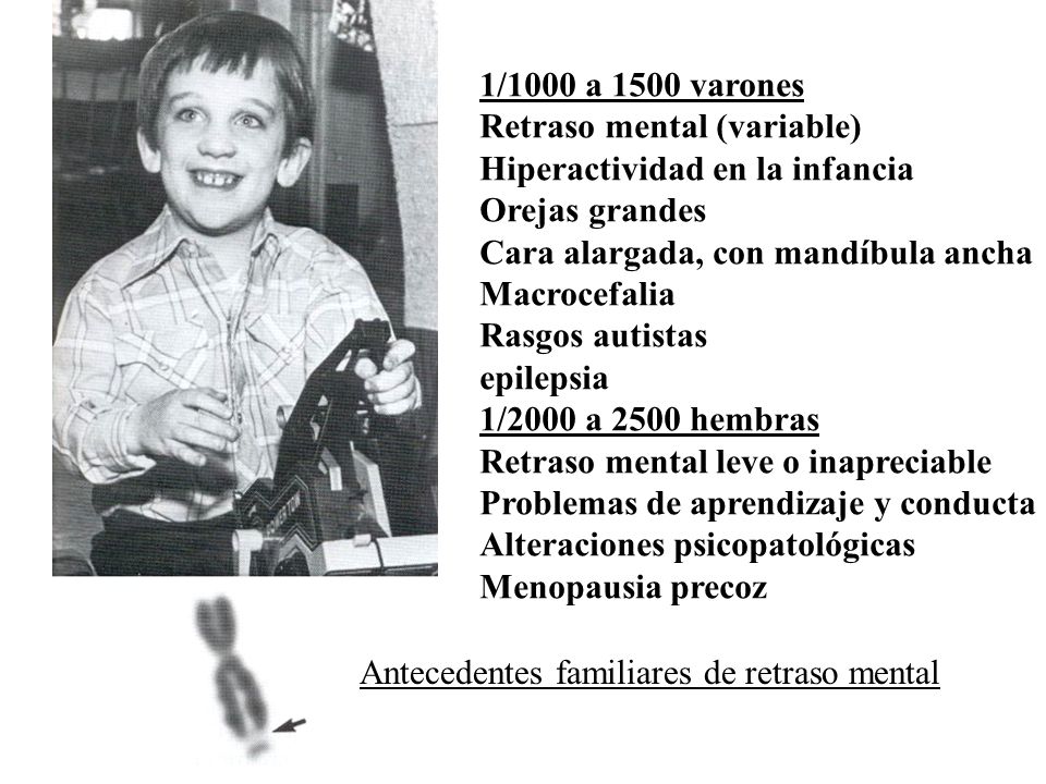 1/1000 a 1500 varones Retraso mental (variable) Hiperactividad en la infancia. Orejas grandes. Cara alargada, con mandíbula ancha.