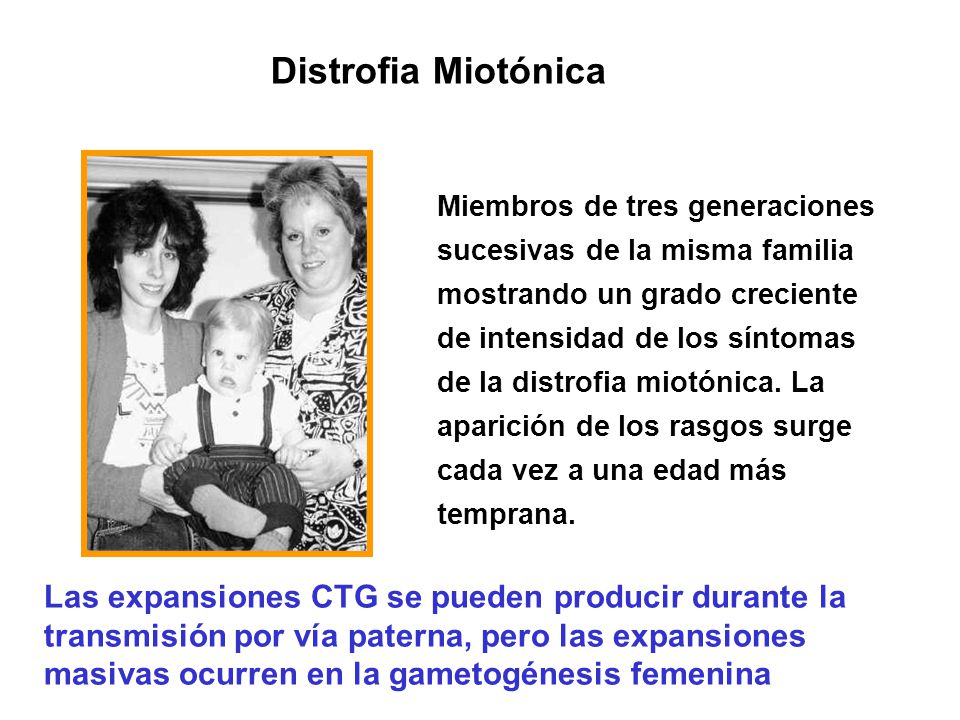 Distrofia Miotónica Miembros de tres generaciones. sucesivas de la misma familia. mostrando un grado creciente.