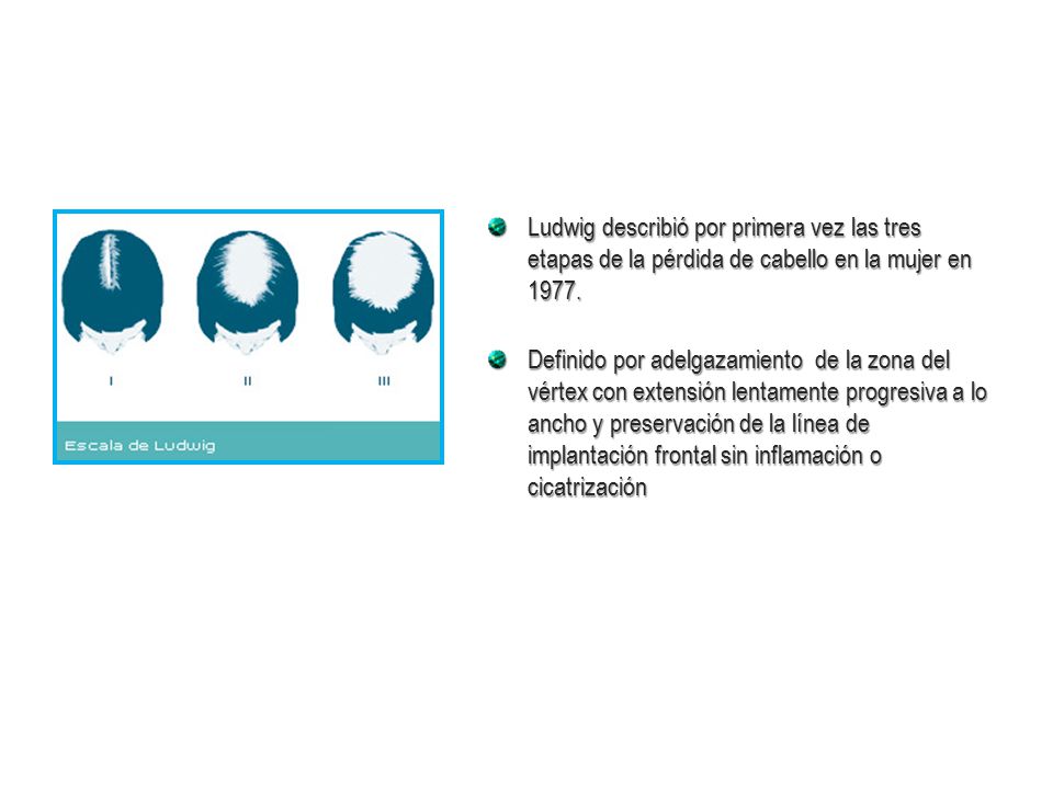 Ludwig describió por primera vez las tres etapas de la pérdida de cabello en la mujer en 1977.