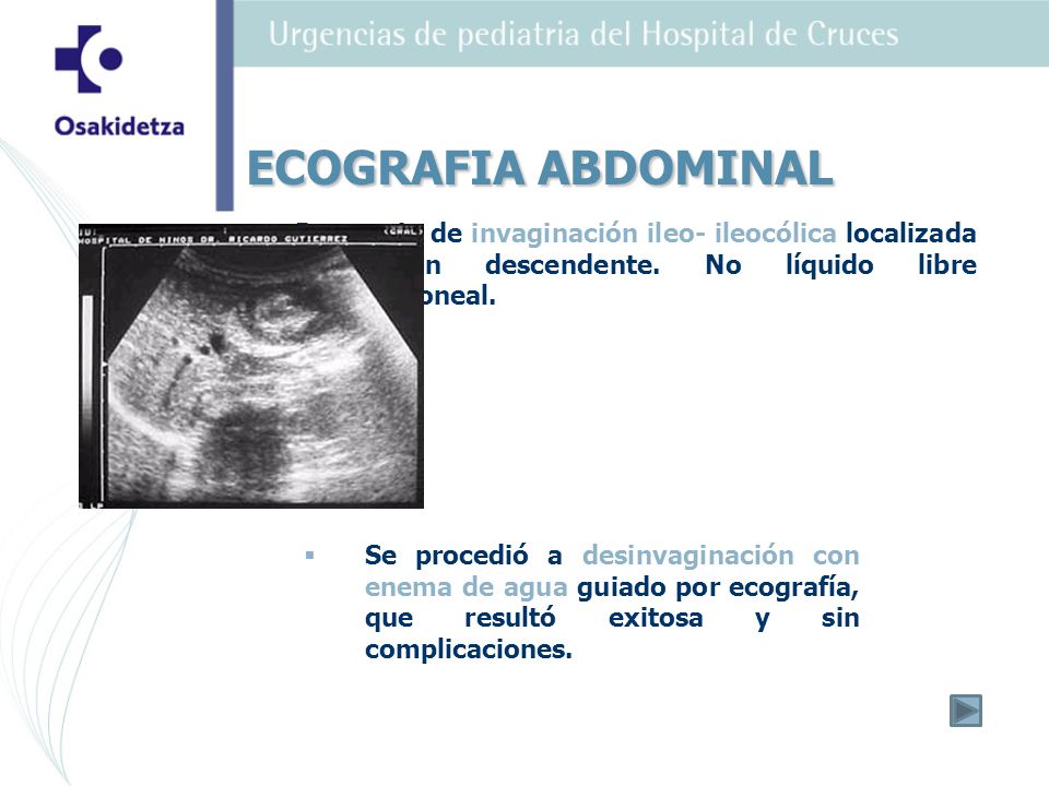 ECOGRAFIA ABDOMINAL Presencia de invaginación ileo- ileocólica localizada en colon descendente. No líquido libre intraperitoneal.