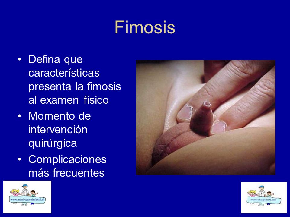 Fimosis Defina que características presenta la fimosis al examen físico. Momento de intervención quirúrgica.