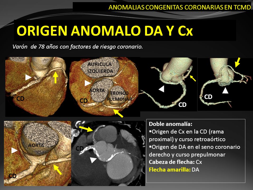 ORIGEN ANOMALO DA Y Cx ANOMALIAS CONGENITAS CORONARIAS EN TCMD CD CD