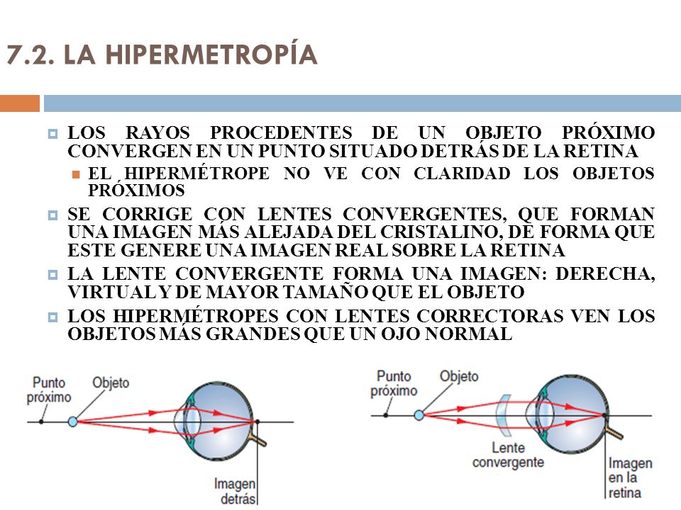 7.2. LA HIPERMETROPÍA LOS RAYOS PROCEDENTES DE UN OBJETO PRÓXIMO CONVERGEN EN UN PUNTO SITUADO DETRÁS DE LA RETINA.