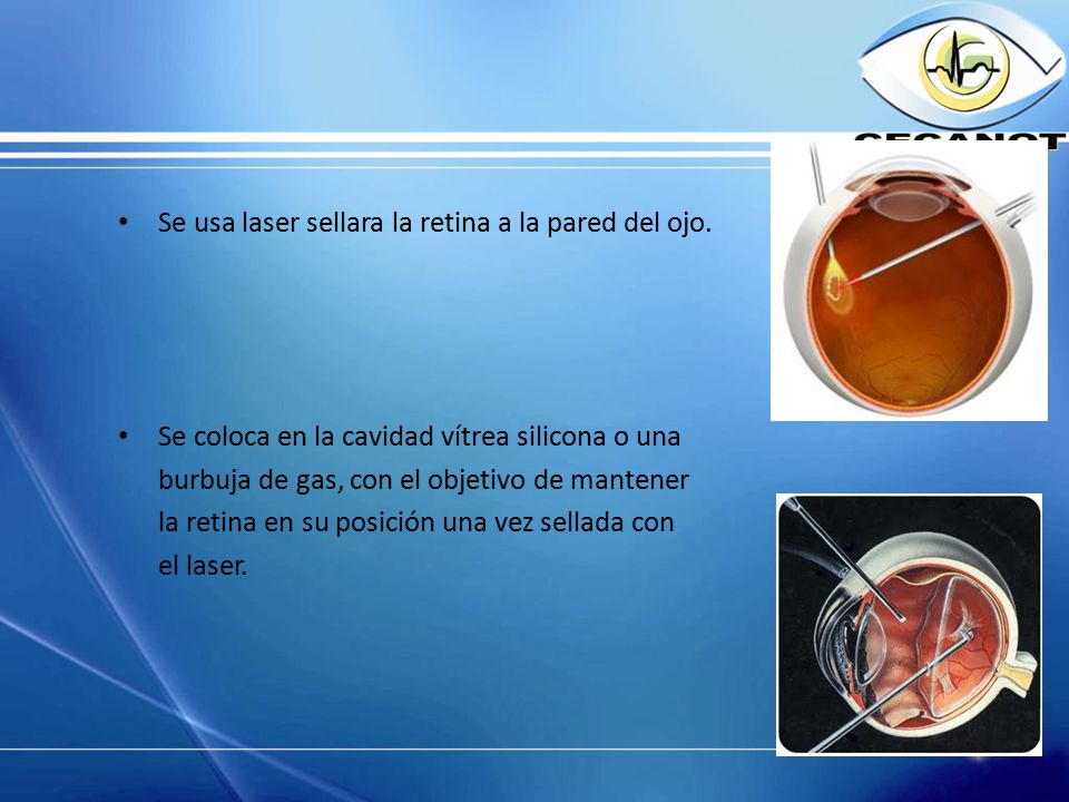 Se usa laser sellara la retina a la pared del ojo.