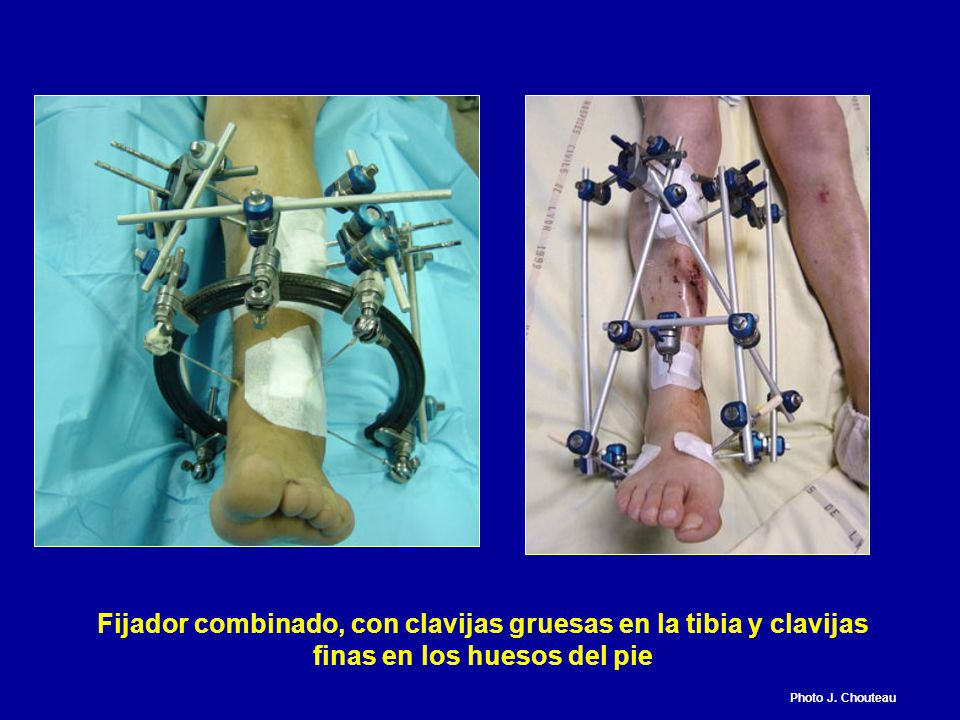 Fijador combinado, con clavijas gruesas en la tibia y clavijas finas en los huesos del pie