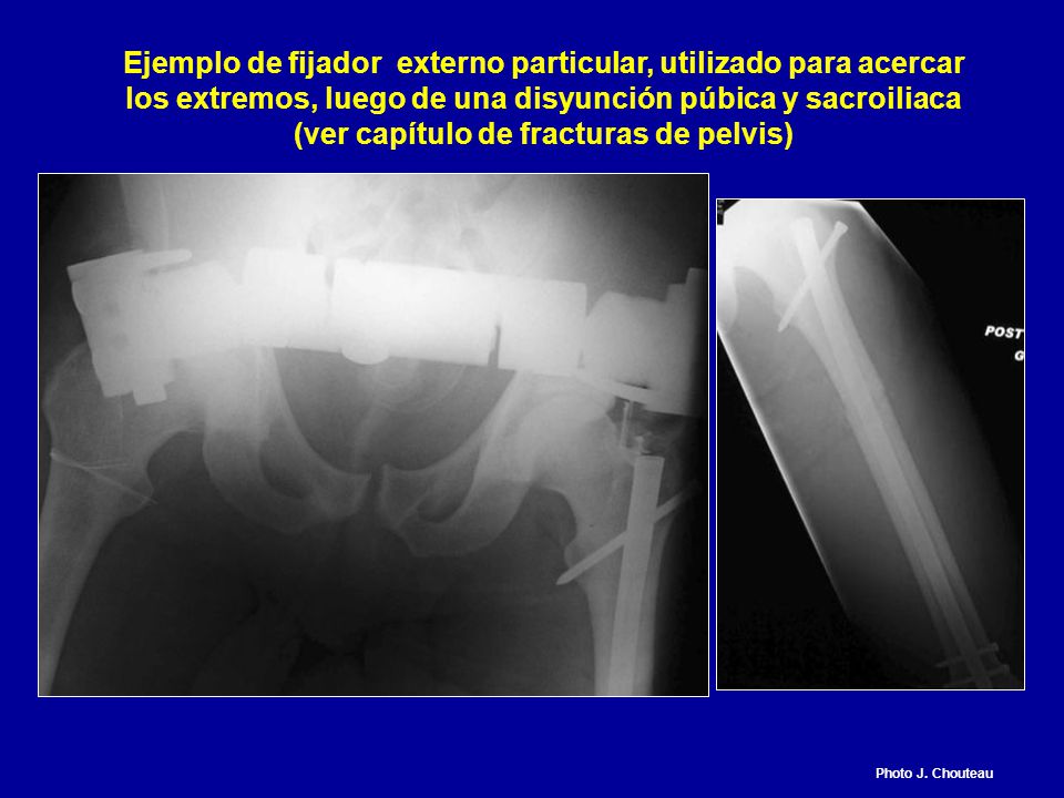 Ejemplo de fijador externo particular, utilizado para acercar los extremos, luego de una disyunción púbica y sacroiliaca (ver capítulo de fracturas de pelvis)