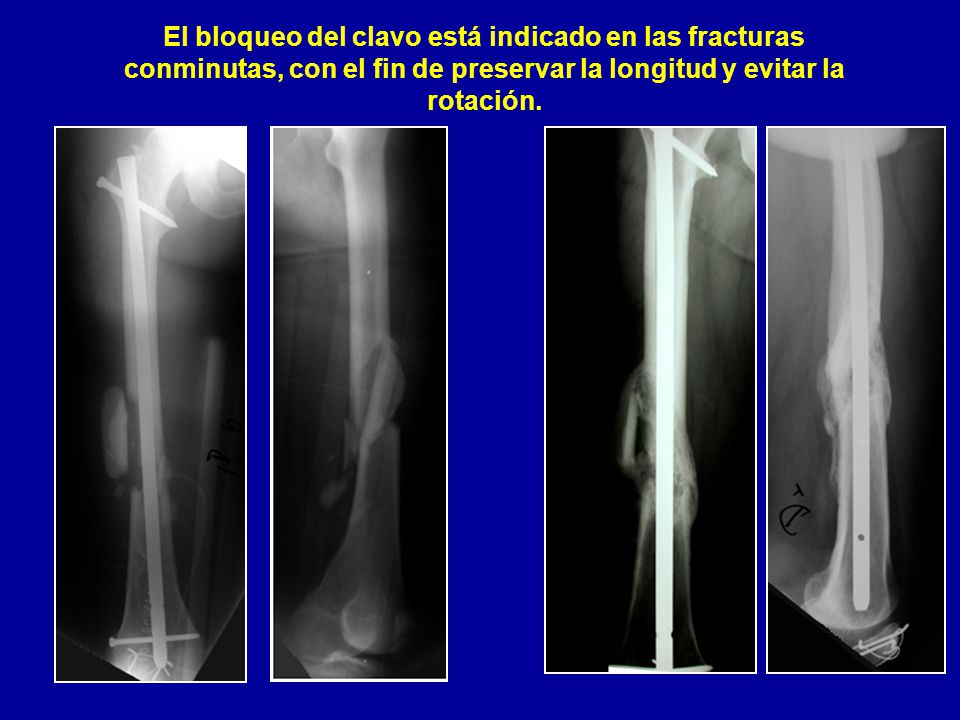 El bloqueo del clavo está indicado en las fracturas conminutas, con el fin de preservar la longitud y evitar la rotación.