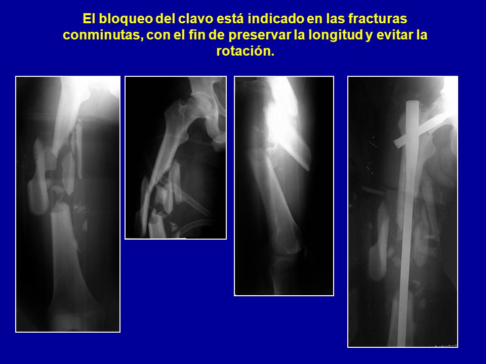 El bloqueo del clavo está indicado en las fracturas conminutas, con el fin de preservar la longitud y evitar la rotación.
