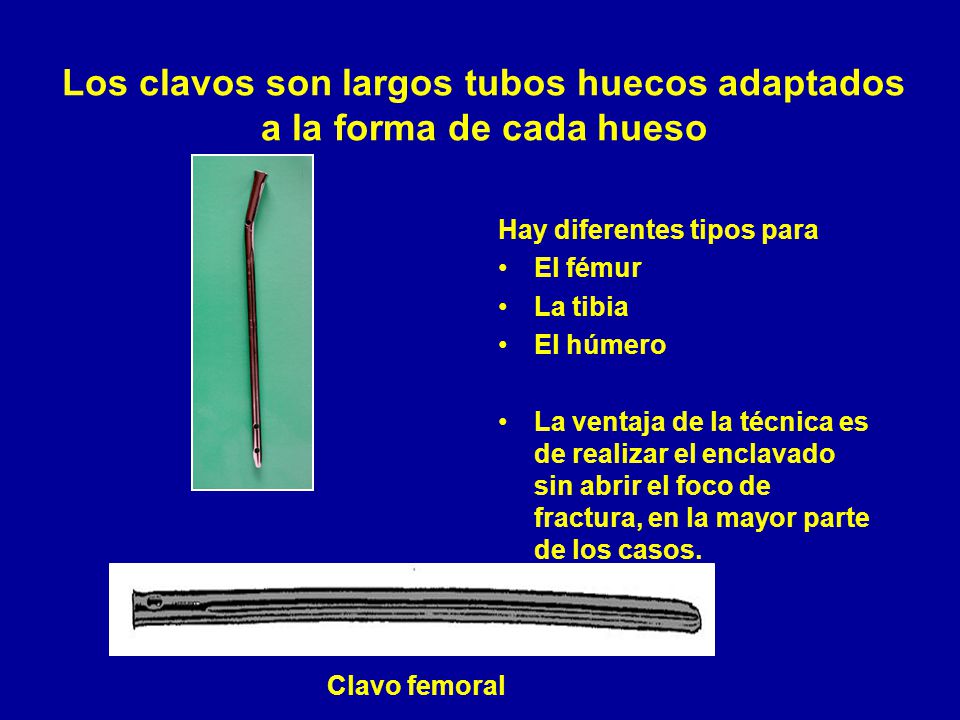 Los clavos son largos tubos huecos adaptados a la forma de cada hueso