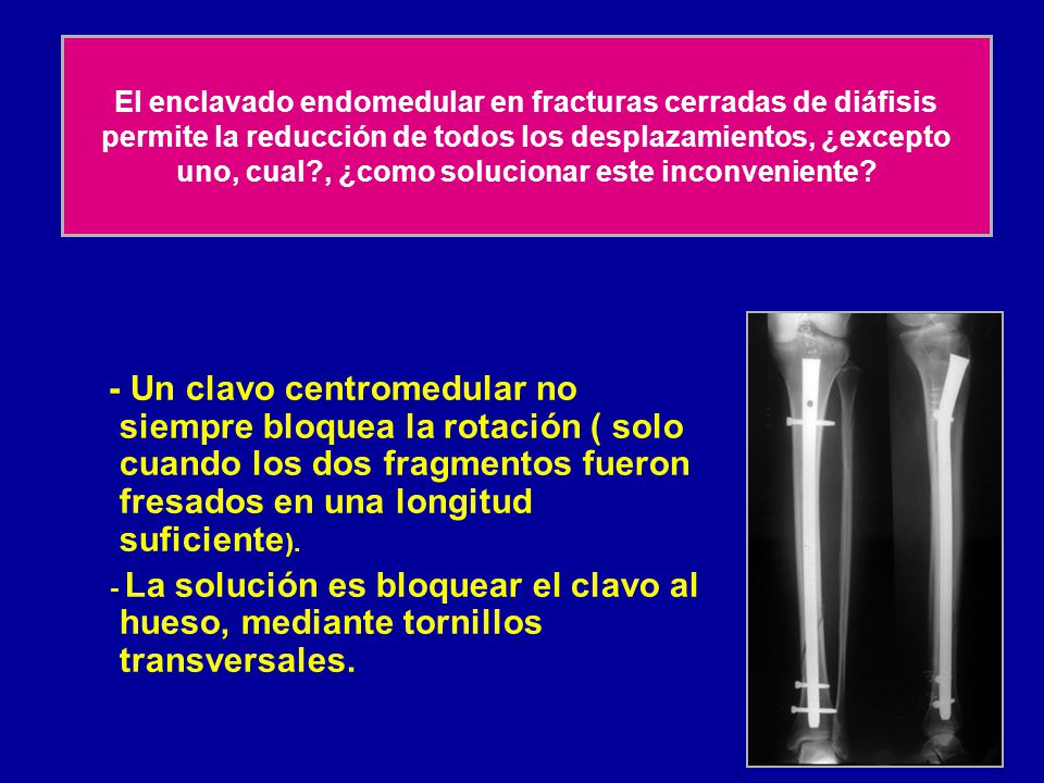 El enclavado endomedular en fracturas cerradas de diáfisis permite la reducción de todos los desplazamientos, ¿excepto uno, cual , ¿como solucionar este inconveniente