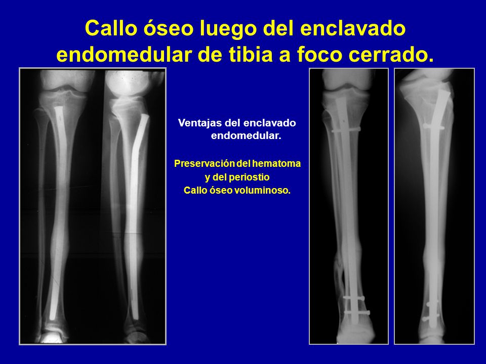 Callo óseo luego del enclavado endomedular de tibia a foco cerrado.