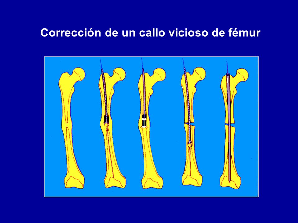 Corrección de un callo vicioso de fémur
