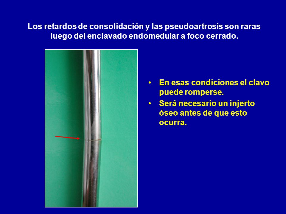 Los retardos de consolidación y las pseudoartrosis son raras luego del enclavado endomedular a foco cerrado.