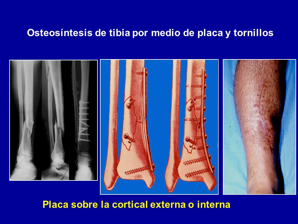 Osteosíntesis de tibia por medio de placa y tornillos