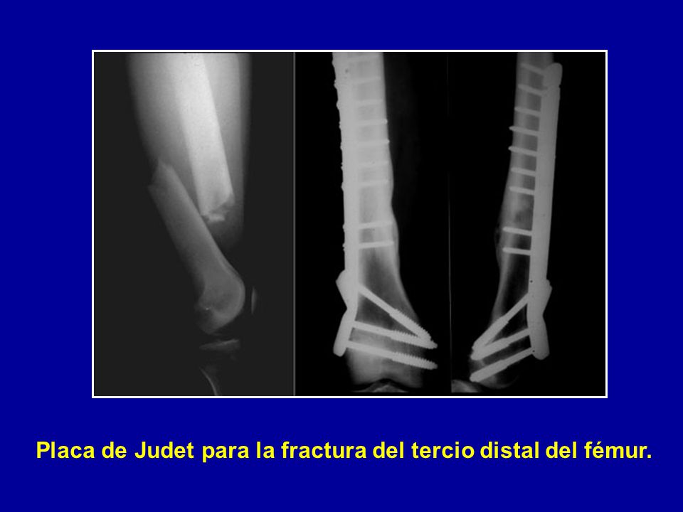 Placa de Judet para la fractura del tercio distal del fémur.