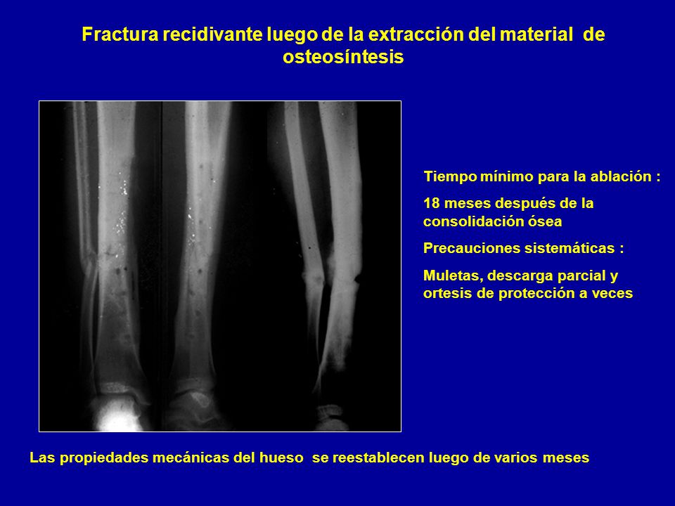 Fractura recidivante luego de la extracción del material de osteosíntesis