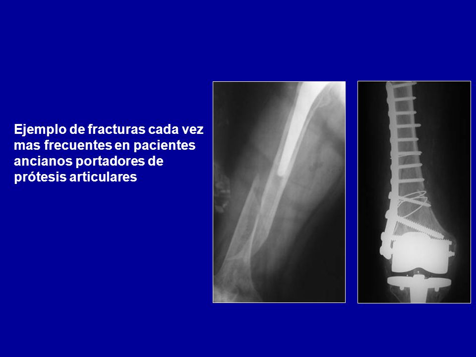 Ejemplo de fracturas cada vez mas frecuentes en pacientes ancianos portadores de prótesis articulares