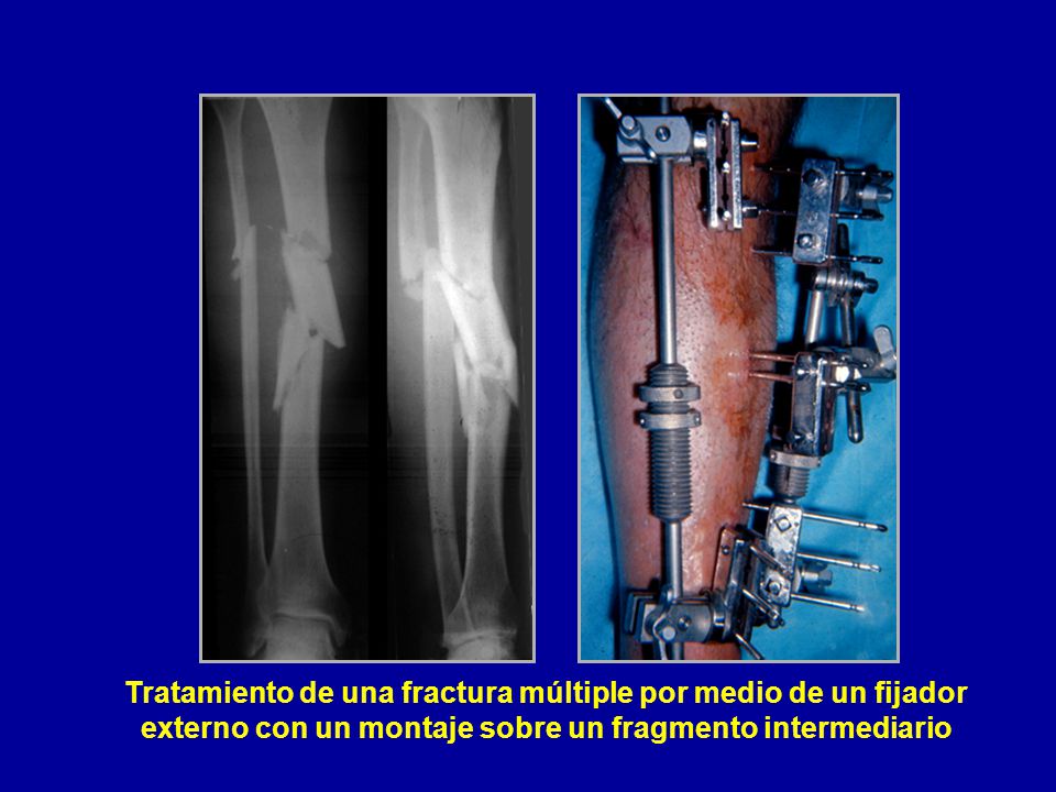 Tratamiento de una fractura múltiple por medio de un fijador externo con un montaje sobre un fragmento intermediario