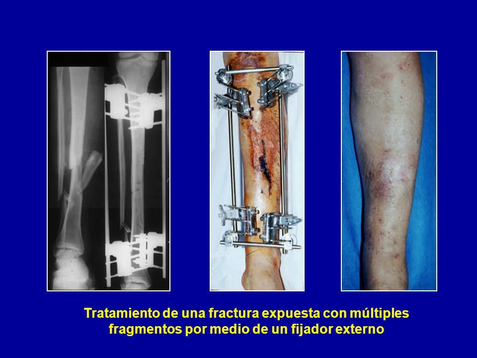 Tratamiento de una fractura expuesta con múltiples fragmentos por medio de un fijador externo