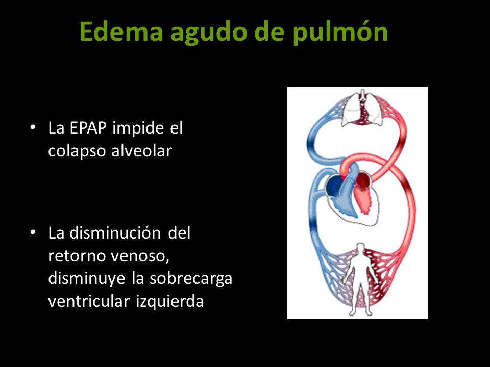 Edema agudo de pulmón La EPAP impide el colapso alveolar