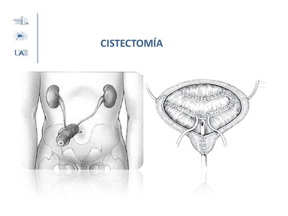 CISTECTOMÍA Una vez que extirpamos la vejiga se indica la técnica más adecuada para derivar la orina al exterior.