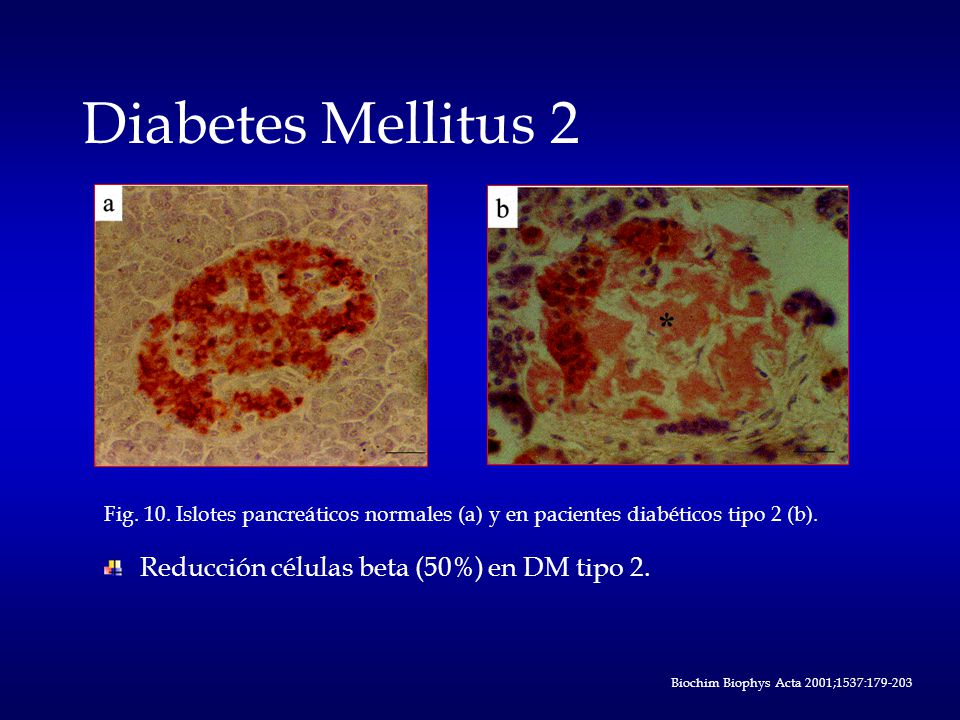 Diabetes Mellitus 2 Reducción células beta (50%) en DM tipo 2.