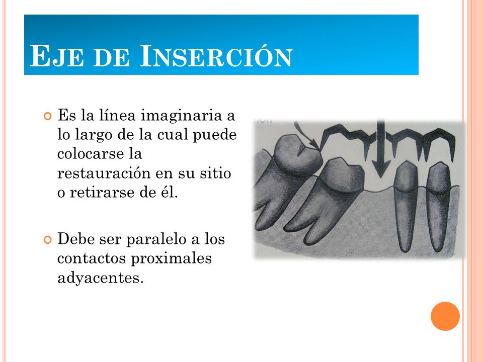 Eje de Inserción Es la línea imaginaria a lo largo de la cual puede colocarse la restauración en su sitio o retirarse de él.