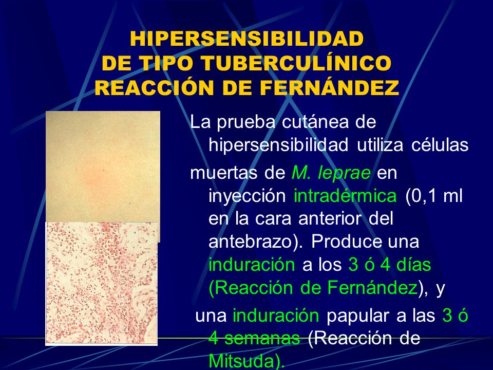 HIPERSENSIBILIDAD DE TIPO TUBERCULÍNICO REACCIÓN DE FERNÁNDEZ