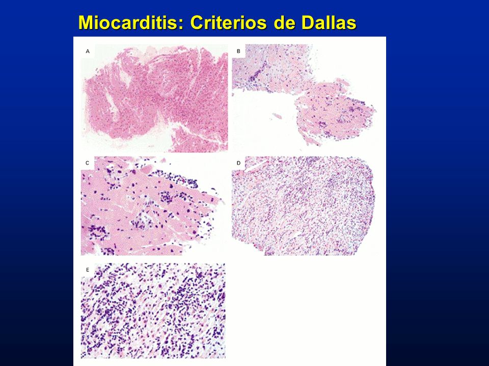 Miocarditis: Criterios de Dallas
