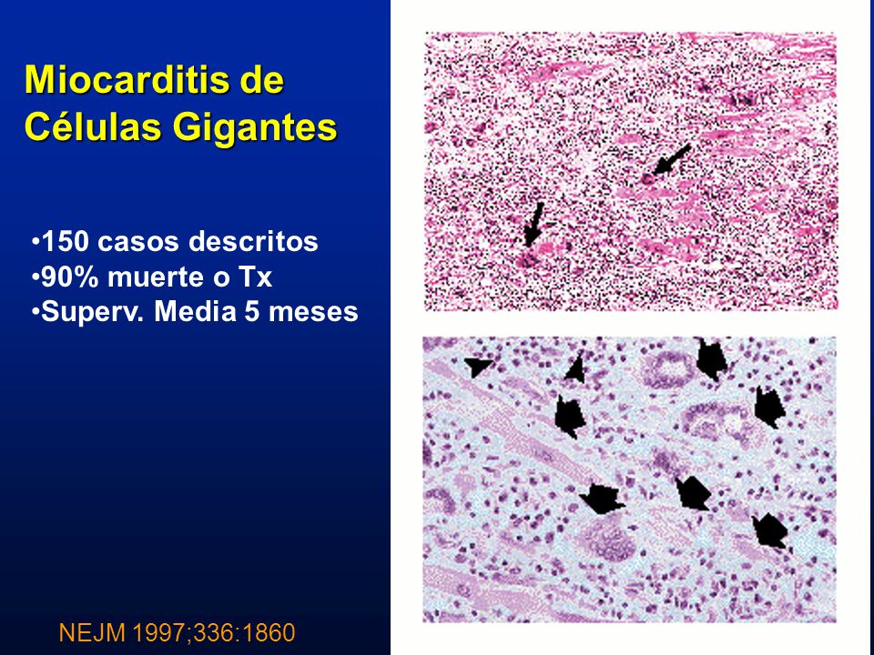 Miocarditis de Células Gigantes 150 casos descritos 90% muerte o Tx