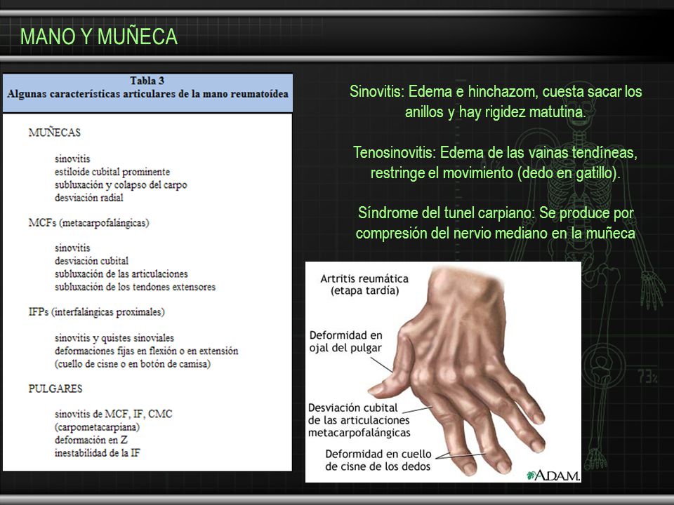 MANO Y MUÑECA Sinovitis: Edema e hinchazom, cuesta sacar los anillos y hay rigidez matutina.
