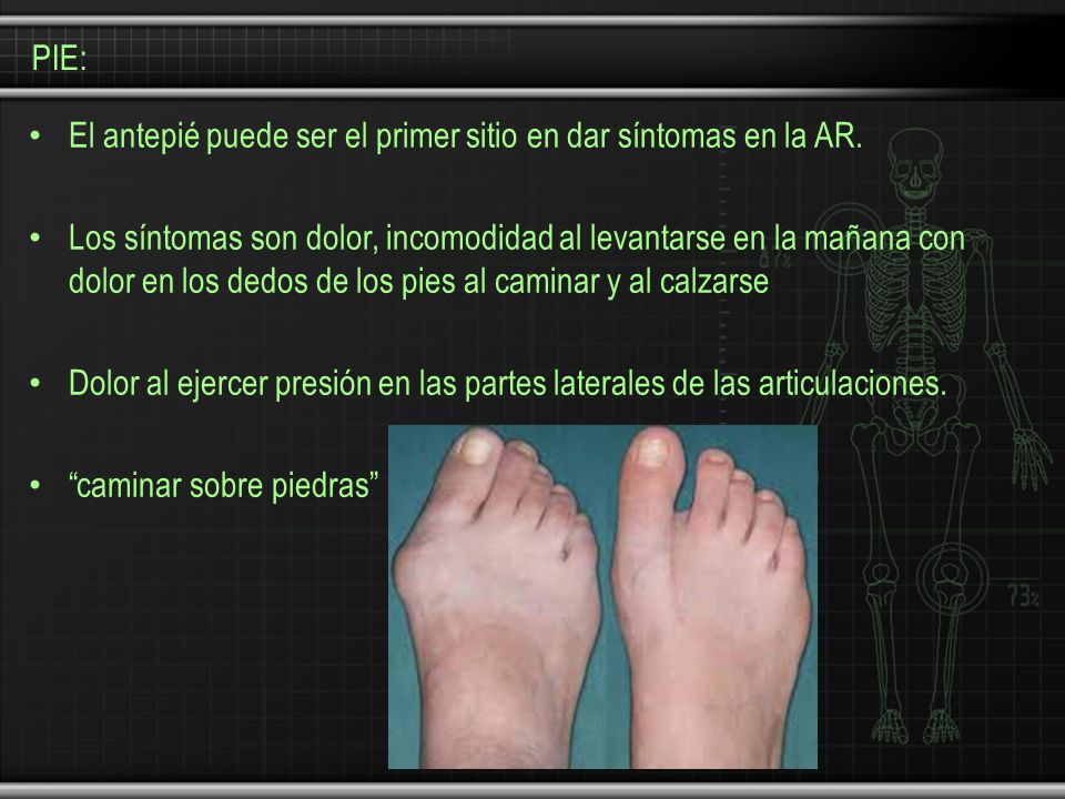 PIE: El antepié puede ser el primer sitio en dar síntomas en la AR.