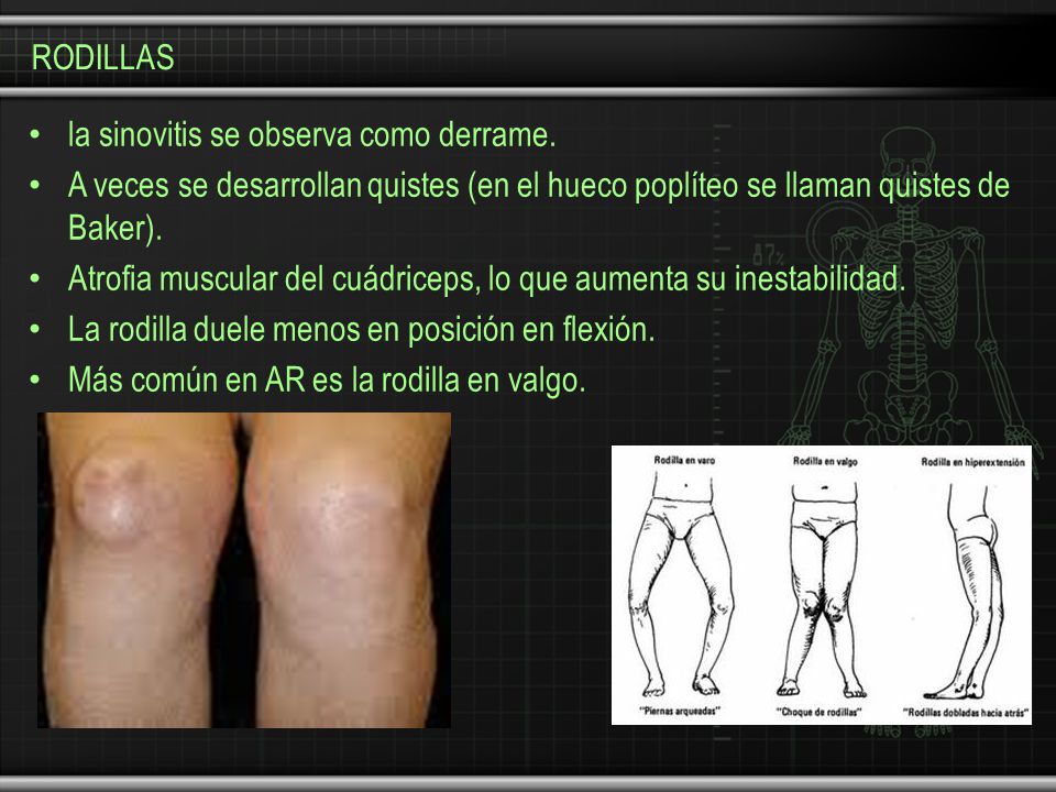 RODILLAS la sinovitis se observa como derrame. A veces se desarrollan quistes (en el hueco poplíteo se llaman quistes de Baker).