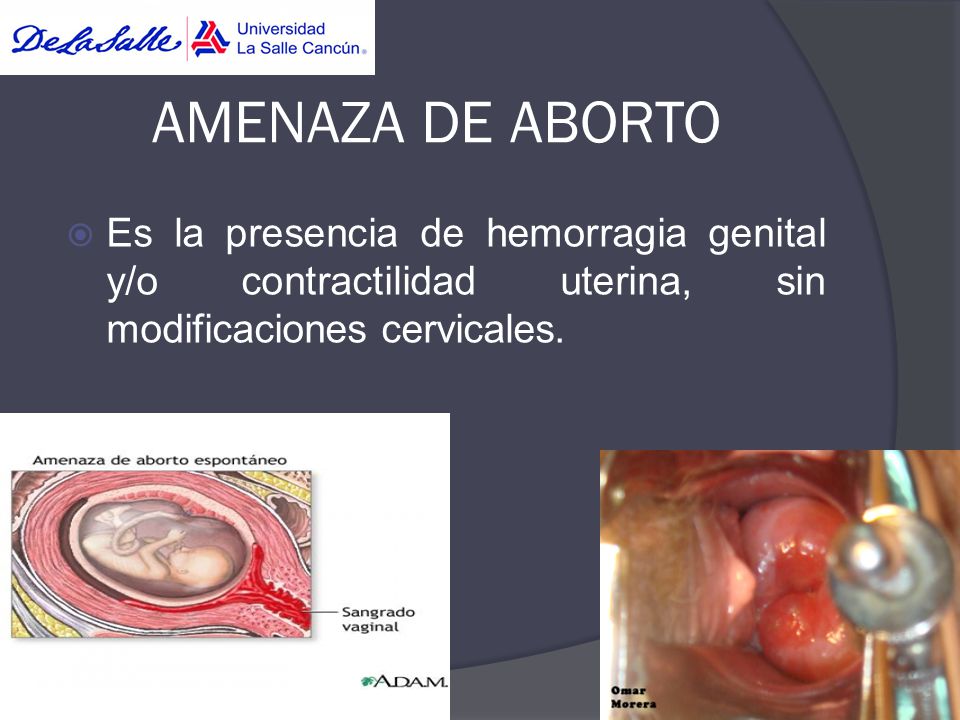 AMENAZA DE ABORTO Es la presencia de hemorragia genital y/o contractilidad uterina, sin modificaciones cervicales.