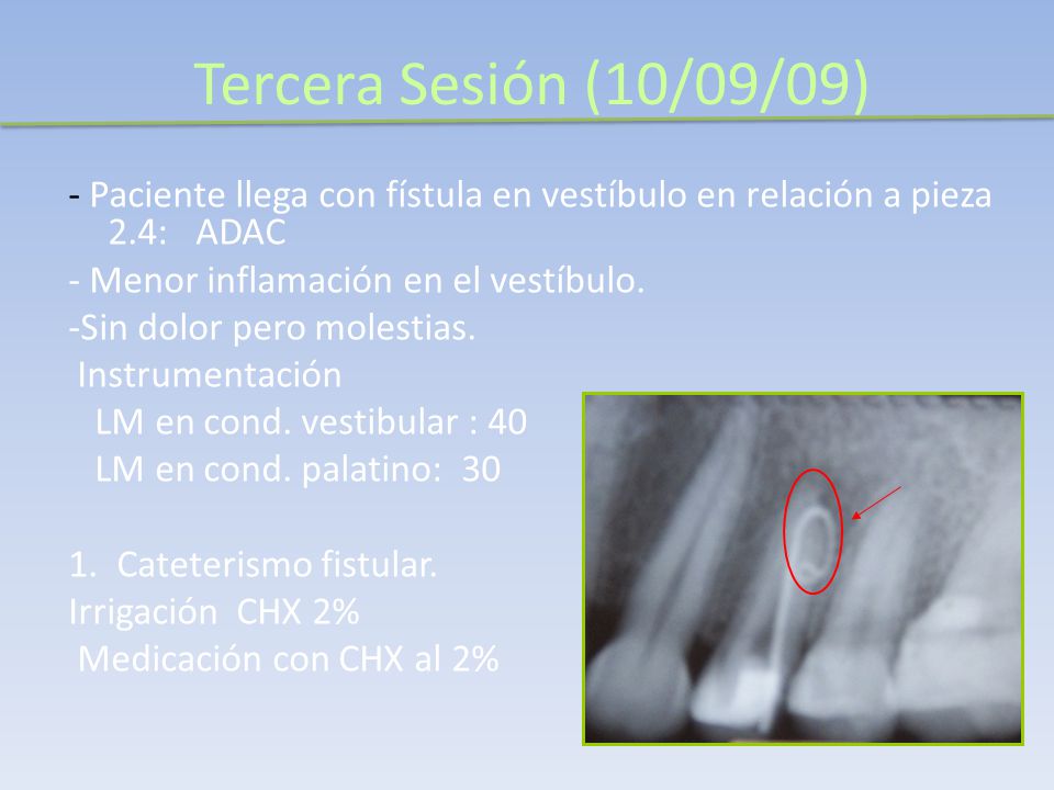 Tercera Sesión (10/09/09) - Paciente llega con fístula en vestíbulo en relación a pieza 2.4: ADAC.