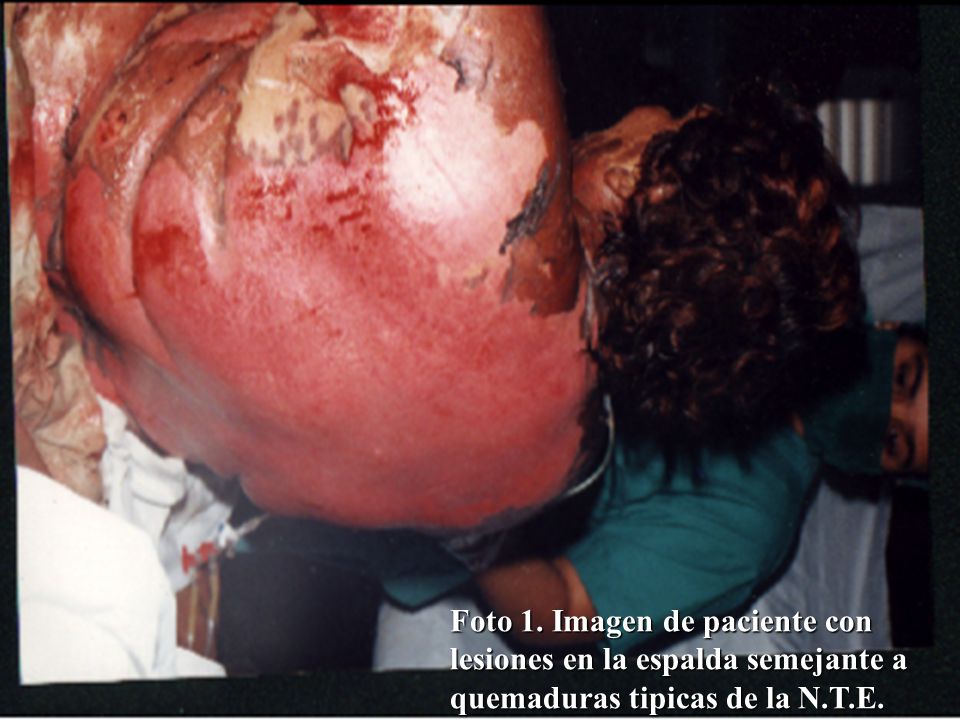 Foto 1. Imagen de paciente con lesiones en la espalda semejante a quemaduras tipicas de la N.T.E.