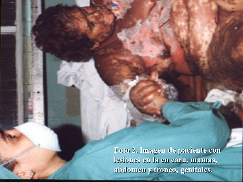 Foto 2. Imagen de paciente con lesiones en la en cara, mamas, abdomen y tronco, genitales.