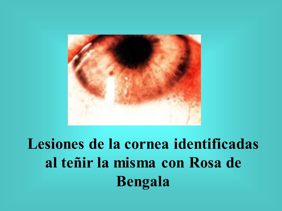 Lesiones de la cornea identificadas al teñir la misma con Rosa de Bengala