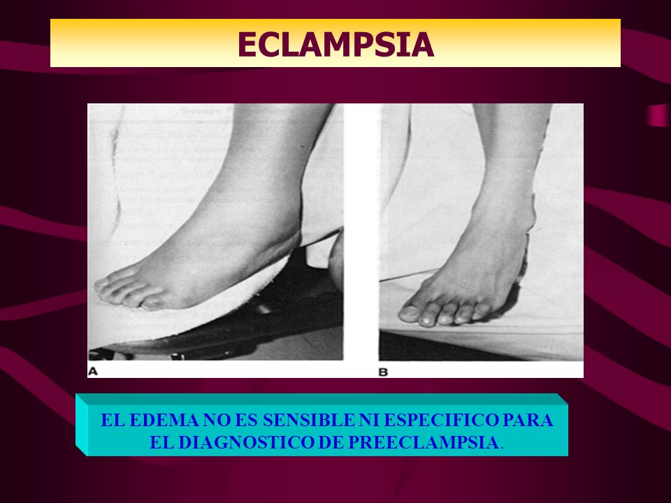 ECLAMPSIA EL EDEMA NO ES SENSIBLE NI ESPECIFICO PARA EL DIAGNOSTICO DE PREECLAMPSIA.
